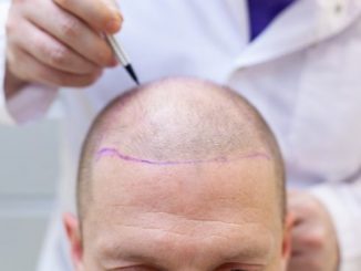 Which country is best for hair transplant?