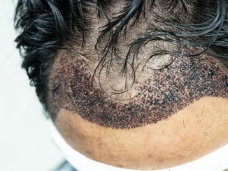 Infected Hair Transplant, What Is It?