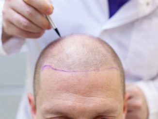 Celebrities with Hair Transplants in USA