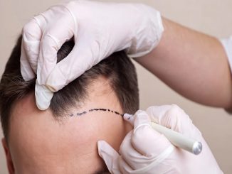 FUE hair transplant