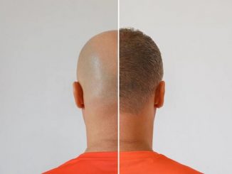 cost a hair transplant