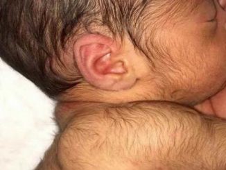 Hypertrichosis