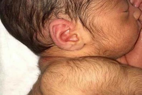 Hypertrichosis